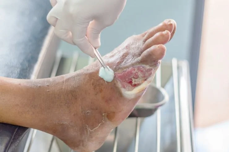 Diabetic Foot Care