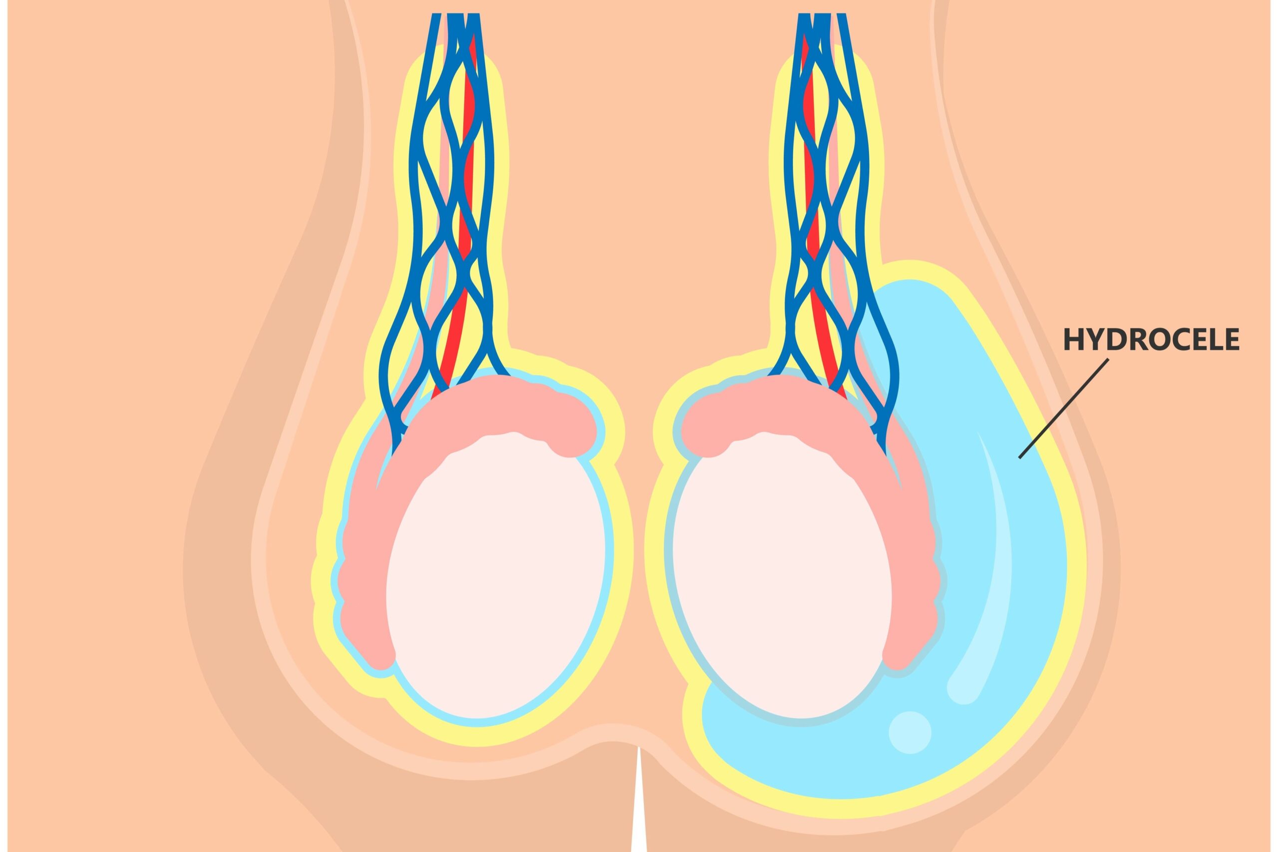 Hydrocele