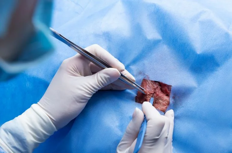 Soft Tissue Tumour Surgeries